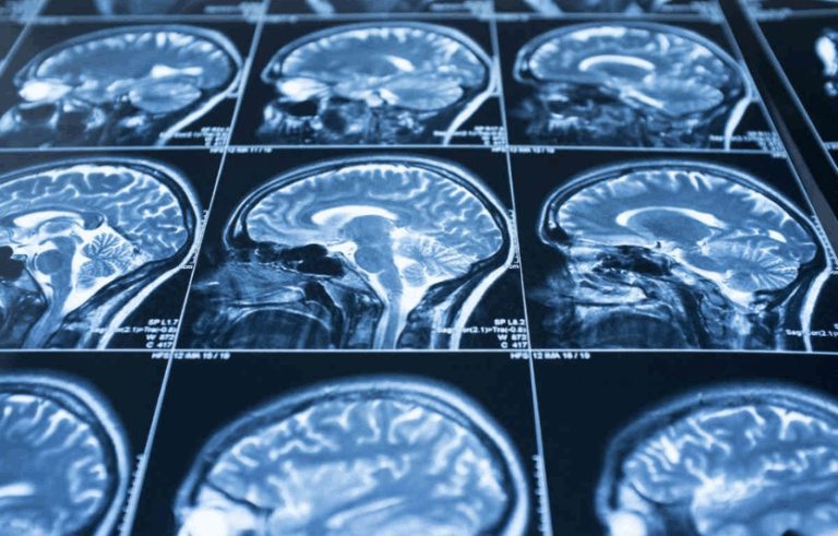 Безпека голови алгоритм повернення до спорту після струсу